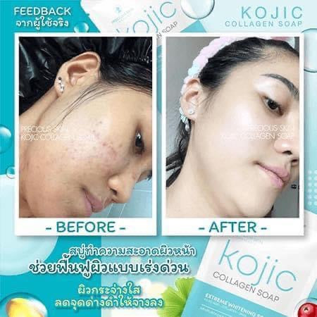 Kojic Collagen Extreme Whitening Soap