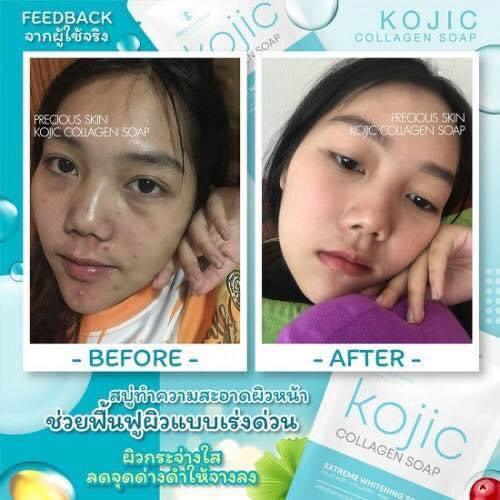 Kojic Collagen Extreme Whitening Soap